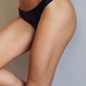 Laser hair removal upper legs