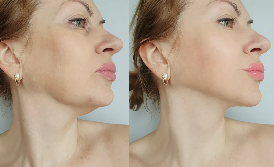 Jawline thread lift results in San Diego