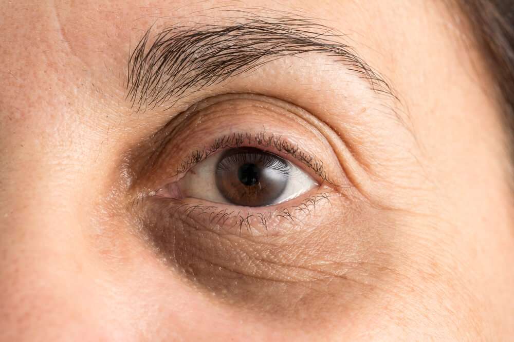 dark circles treatment PRF San Diego