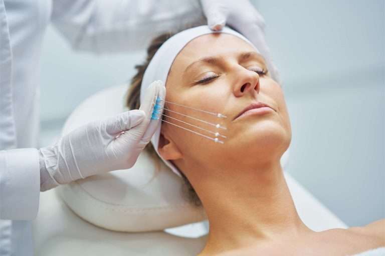PDO threads treatment with benefits in San Diego