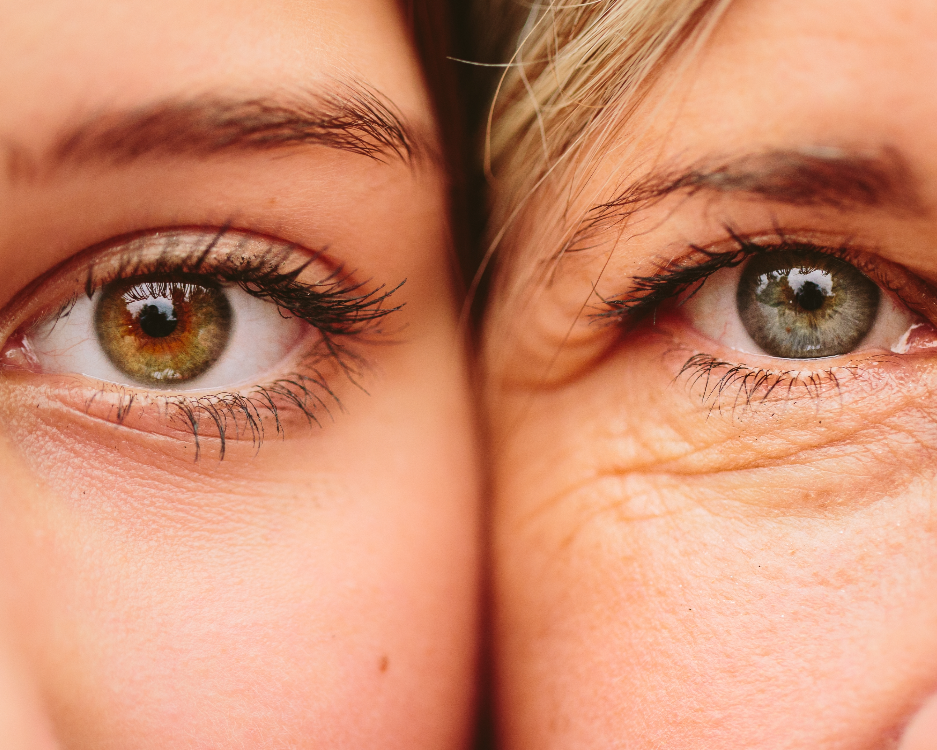 PRF under-eye filler San Diego treatment. Natural Under Eye Rejuvenation