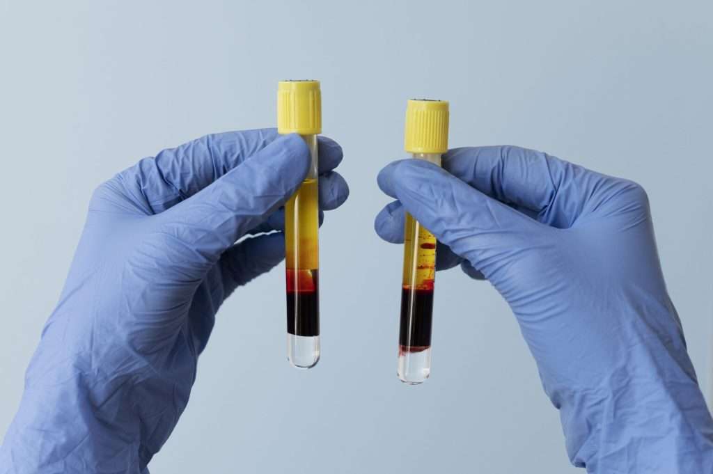 PRF preparation medical spa
