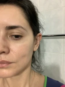 Possible side effects of a thread lift