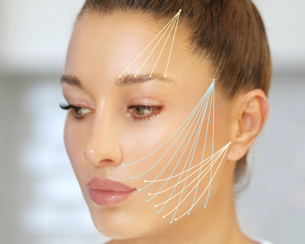PDO Thread Lift San Diego patient treatment