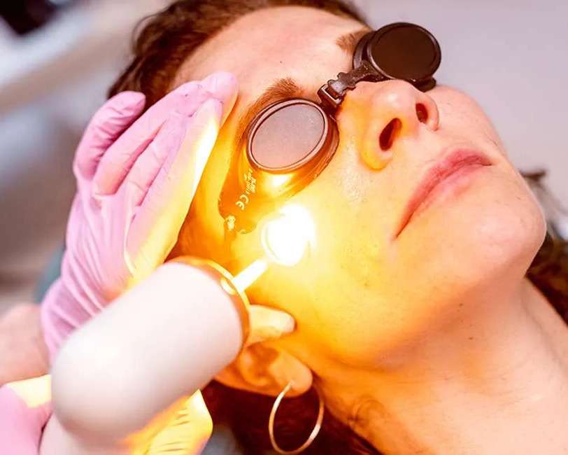 laser facial San Diego treatment session for uneven skin tone