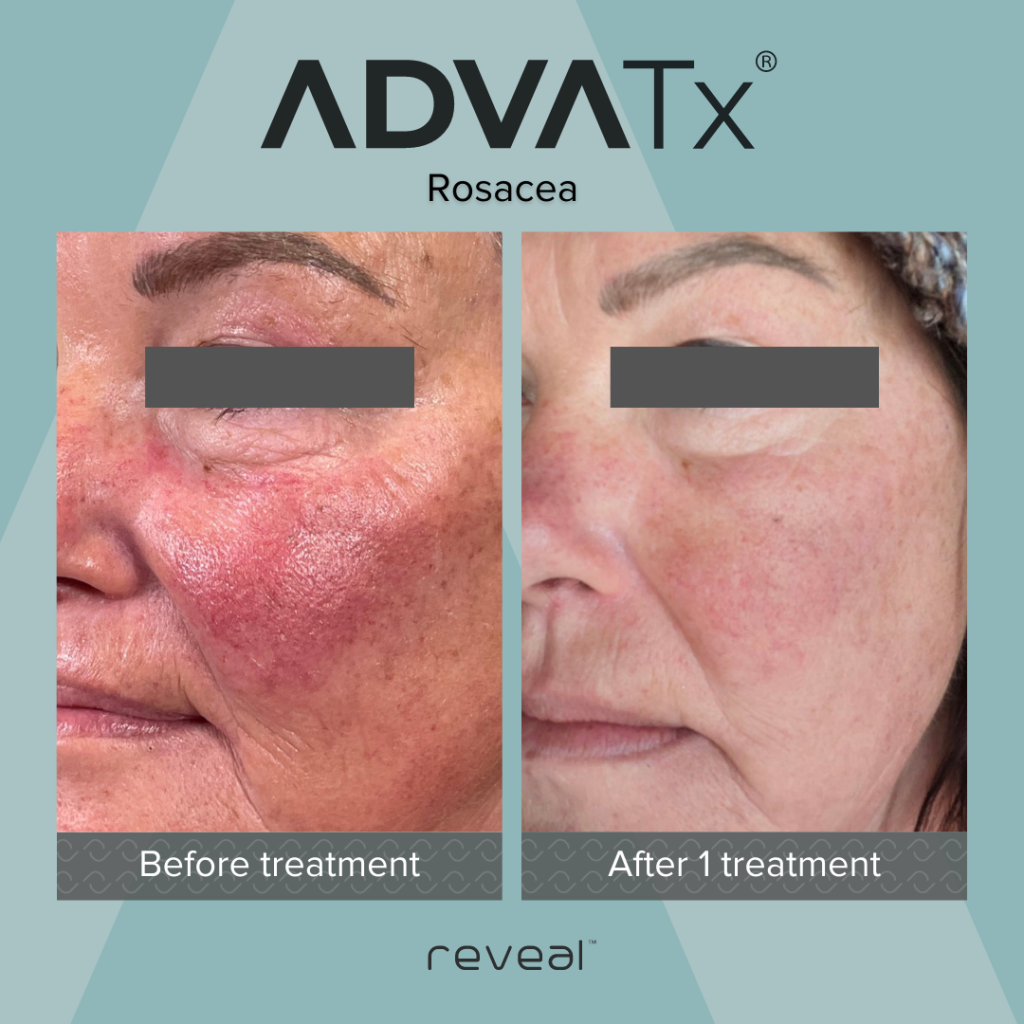 AdvaTx results smoother skin texture