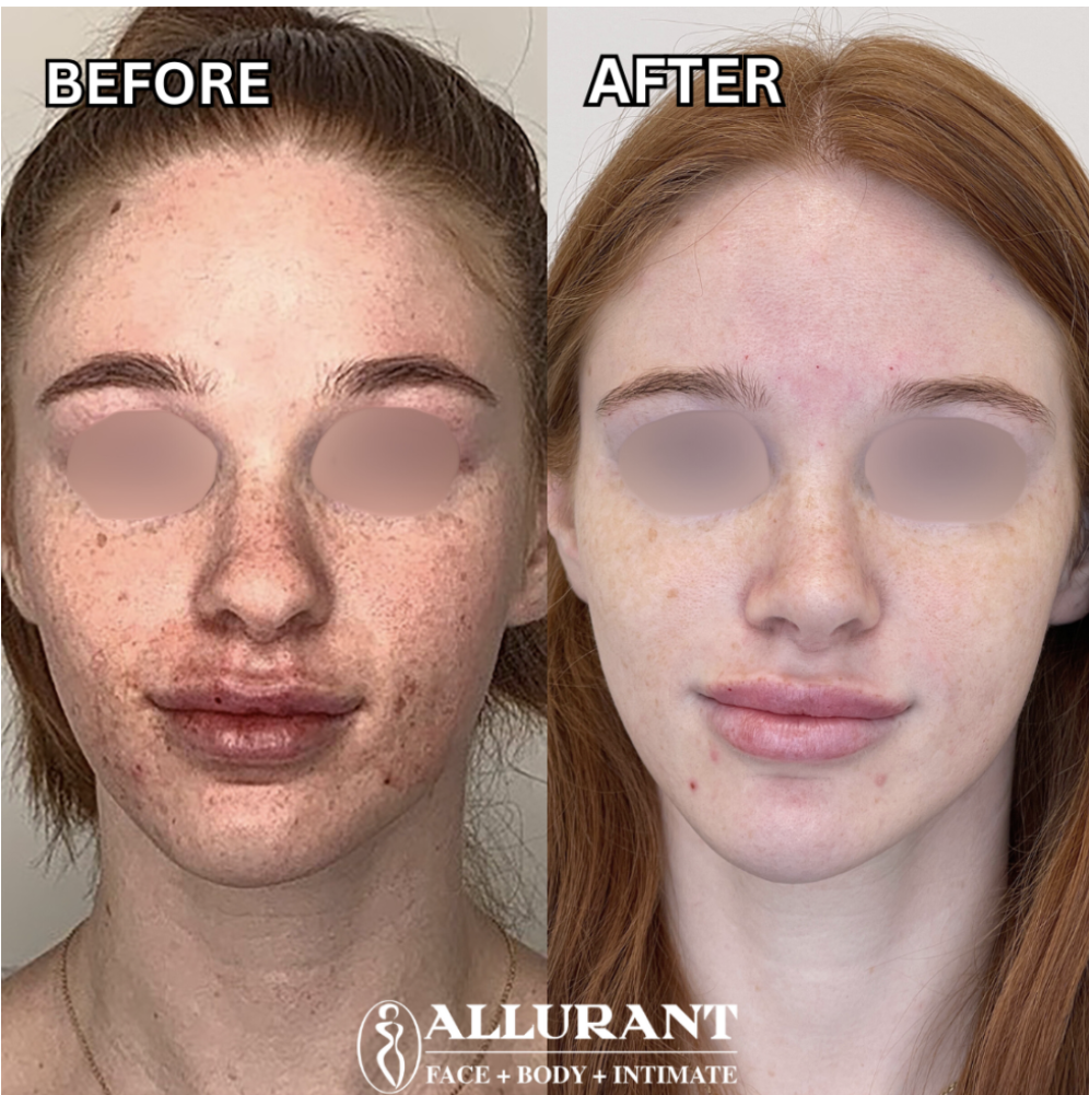clear skin laser San Diego close up skin improvement