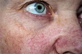 Patient with broken capillaries under the eyes