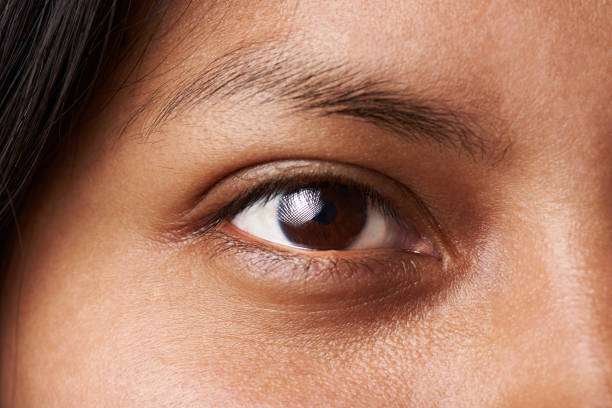 how to fix dark circles professional treatment