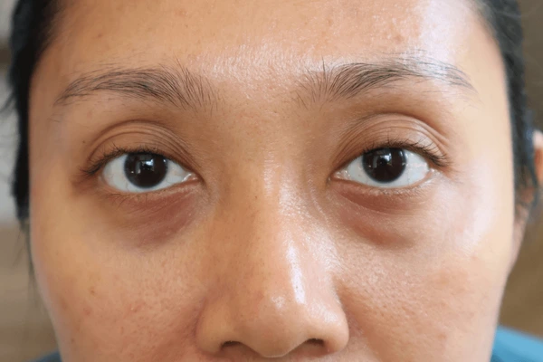Patient with a combination of puffiness and dark circles under the eyes
