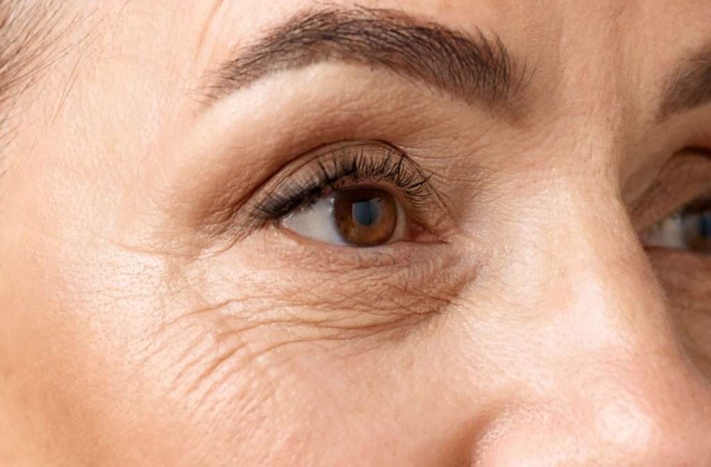 Patient with fine lines and wrinkles around the eyes
