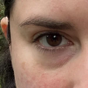 eye bag treatment San Diego non surgical solution