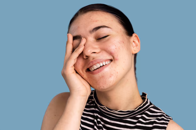 Medical facial for acne-prone skin in San Diego designed to reduce breakouts.