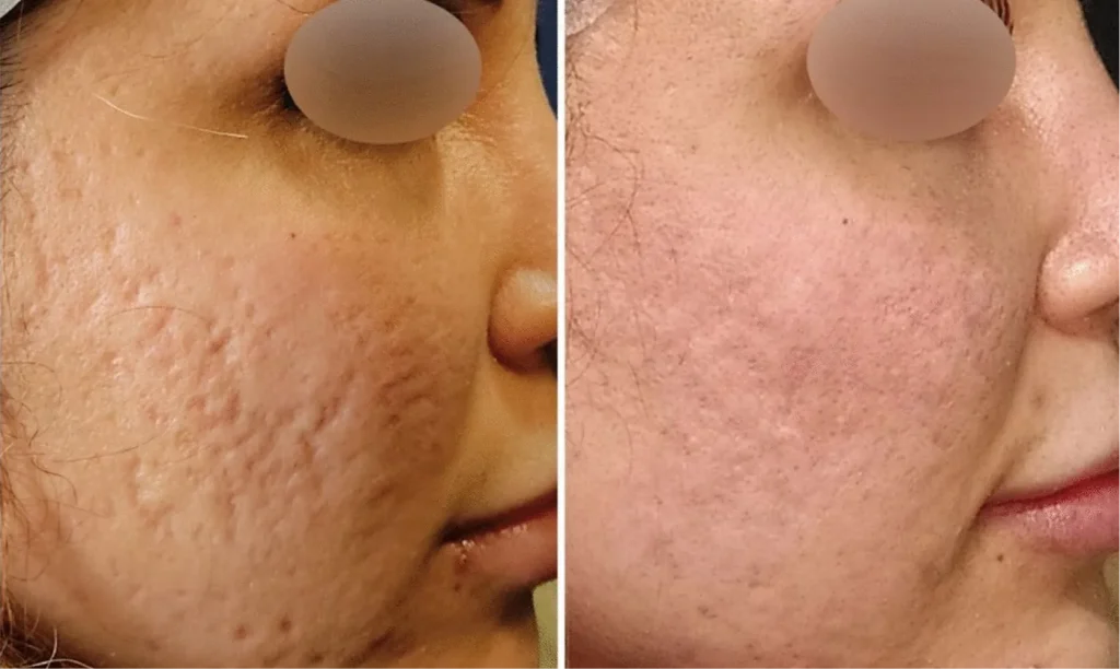 Before and after results of acne scar treatment in San Diego showing skin improvement.