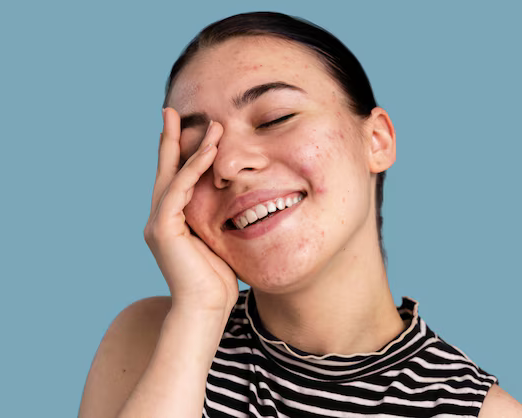 Acne-prone skin in San Diego designed to reduce breakouts.