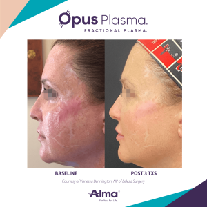 Opus plasma procedure before and after