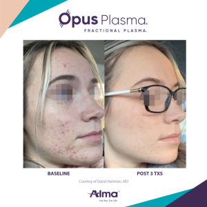 Opus plasma pre and post treatment