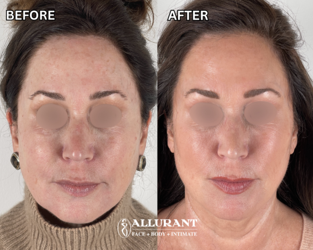 IPL facial San Diego before and after results