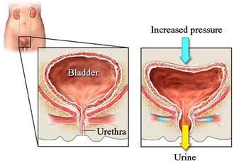 overactive bladder treatment relief San Diego diagram