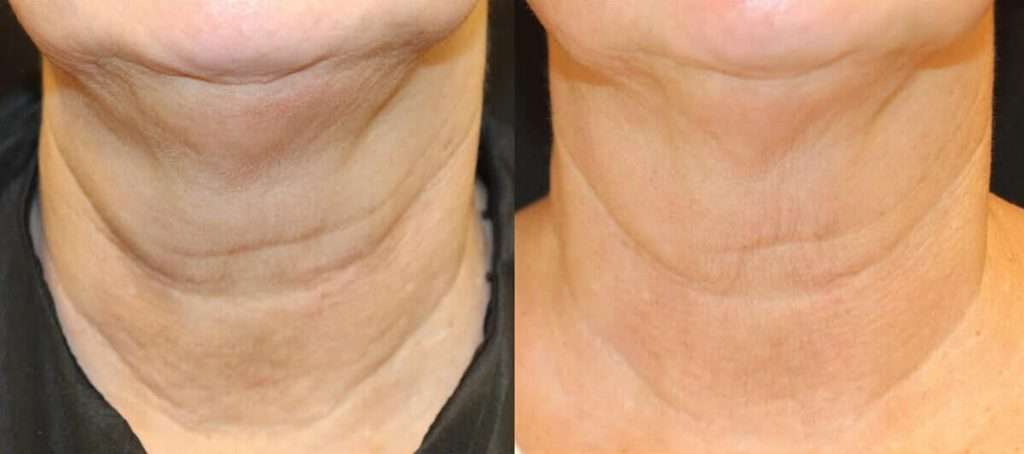best anti-aging treatments San Diego before and after