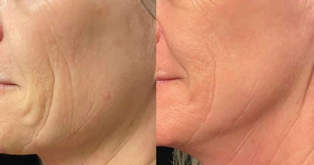collagen production treatment San Diego skin improvement