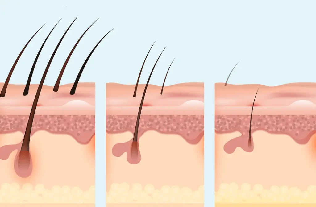 permanent hair reduction legs San Diego