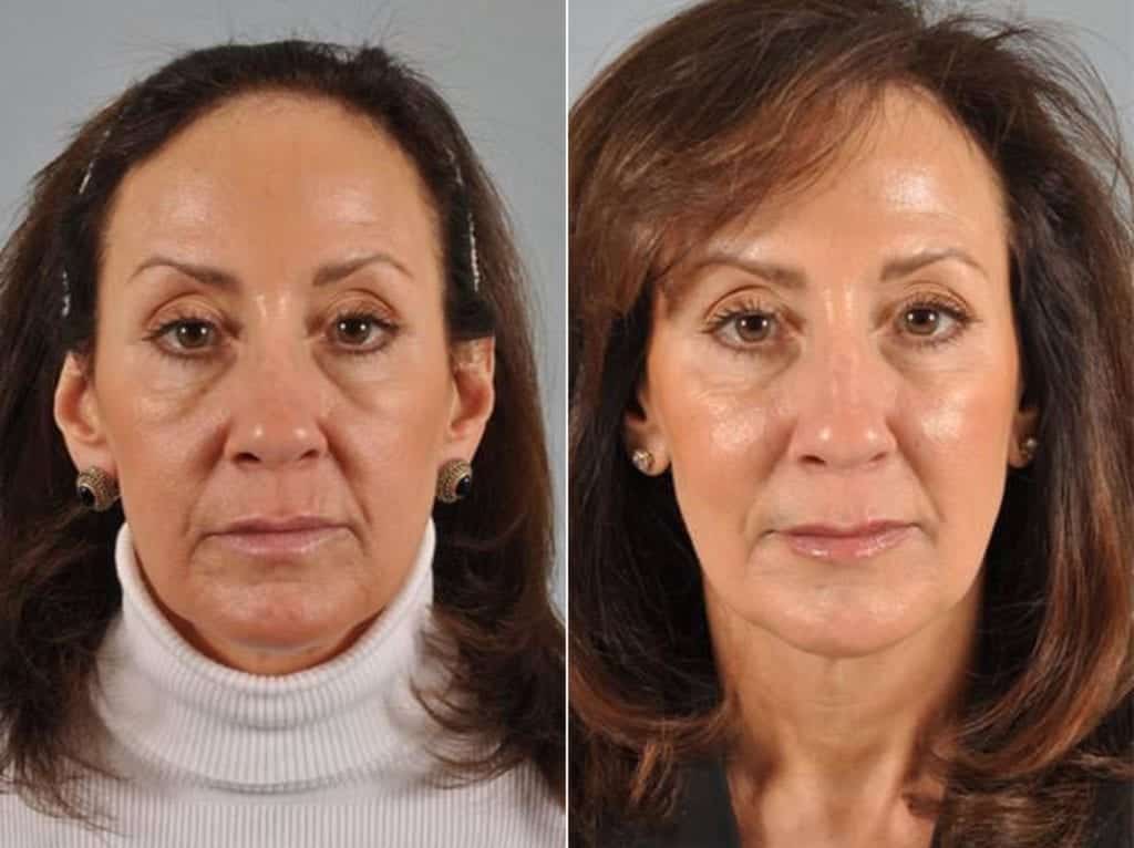 reverse aging San Diego anti-aging treatment results