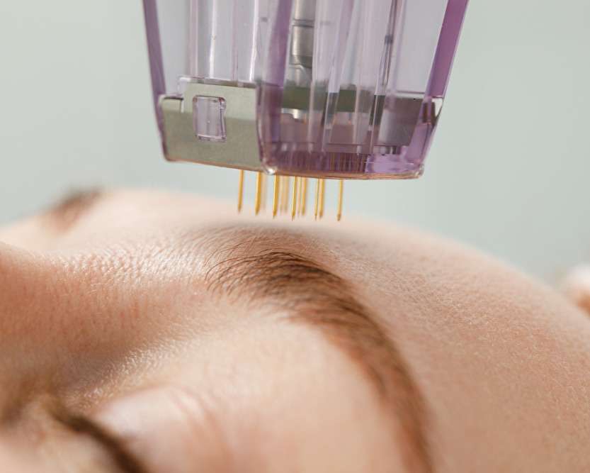 RF microneedling treatment San Diego
