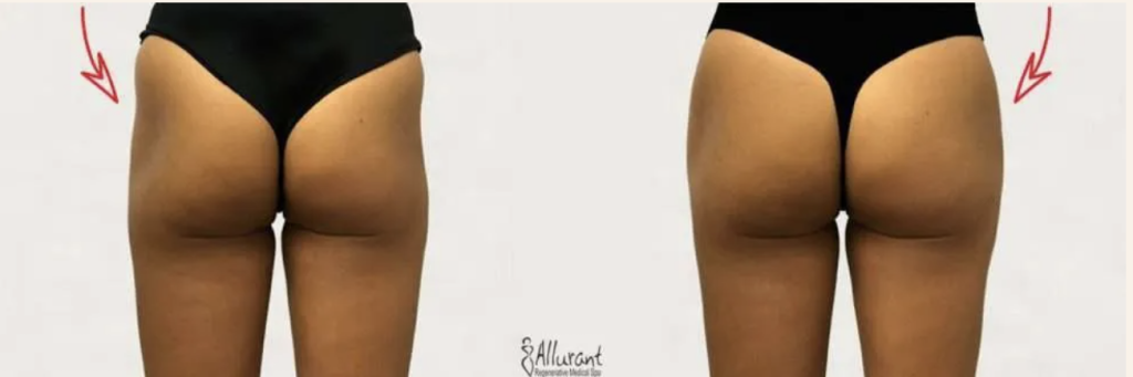 Sculptra before and after butt enhancement results