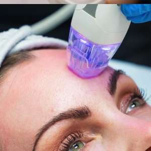 RF Microneedling for Face