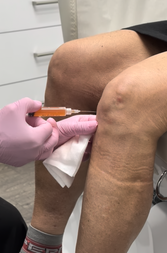 PRF tendonitis treatment procedure