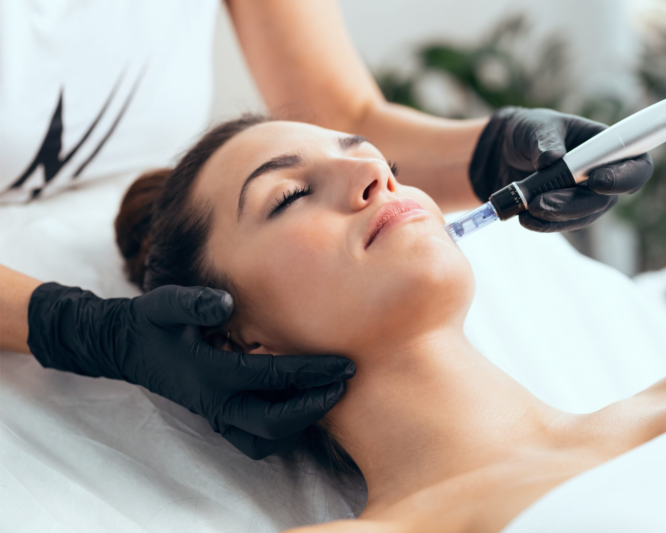 Scarlet RF microneedling San Diego facial treatment