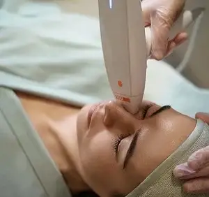 Viva Fractional RF Face 1 Session