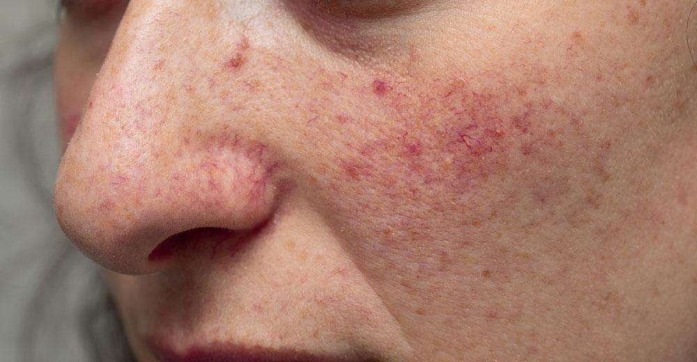 broken capillaries facial redness ADVATx laser treatment