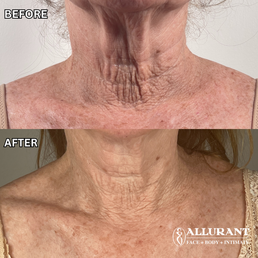 ADVATx laser neck chest pigmentation before and after results