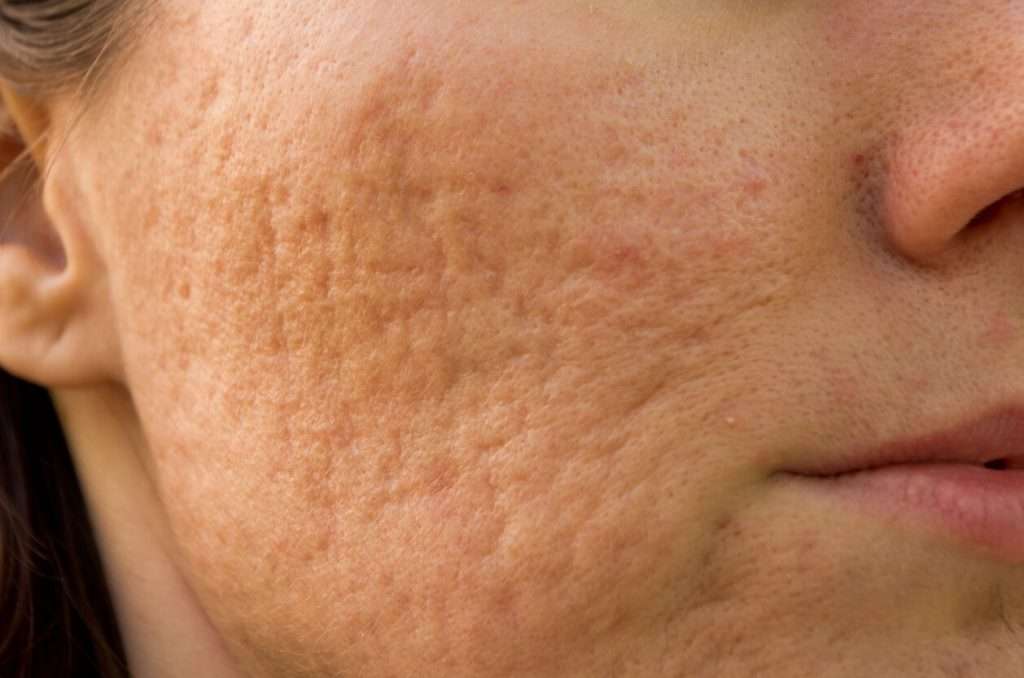 acne scars uneven skin tone improvement ADVATx laser treatment