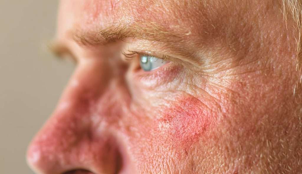 rosacea facial redness treatment ADVATx laser San Diego