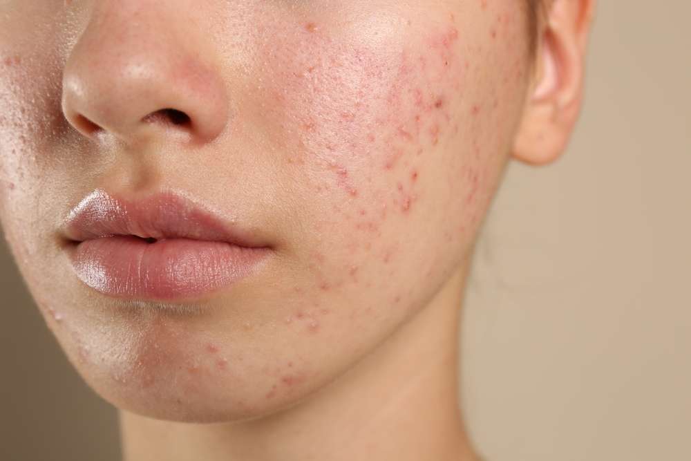 acne prone skin treatment ADVATx laser therapy