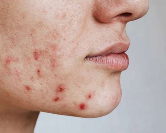 Acne and Acne Scar Treatments In San Diego