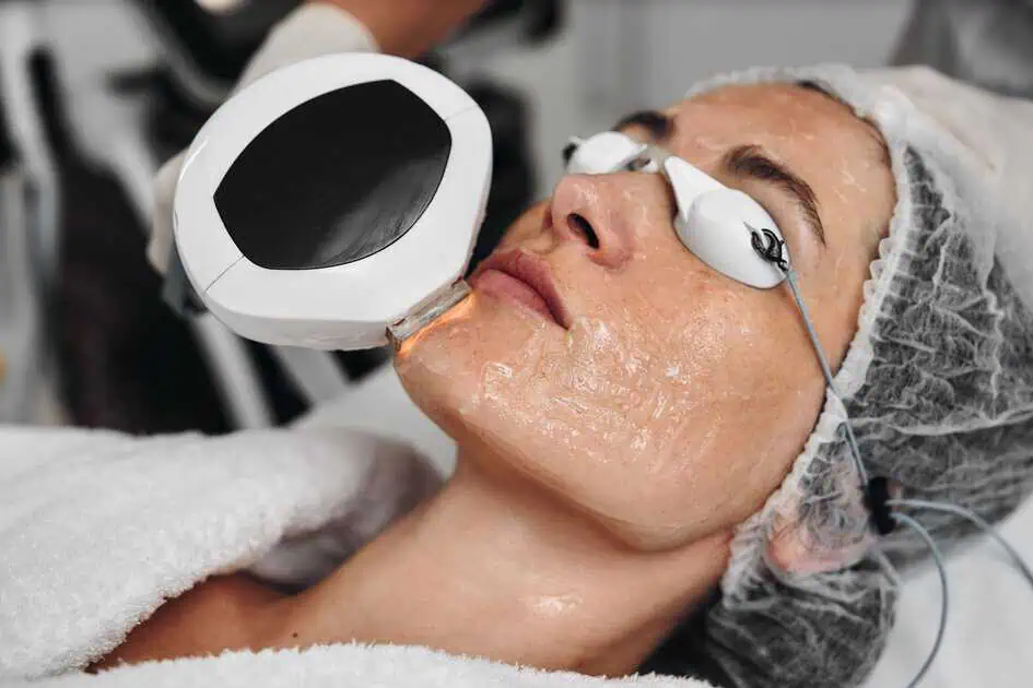 photofacial for scars skin rejuvenation results