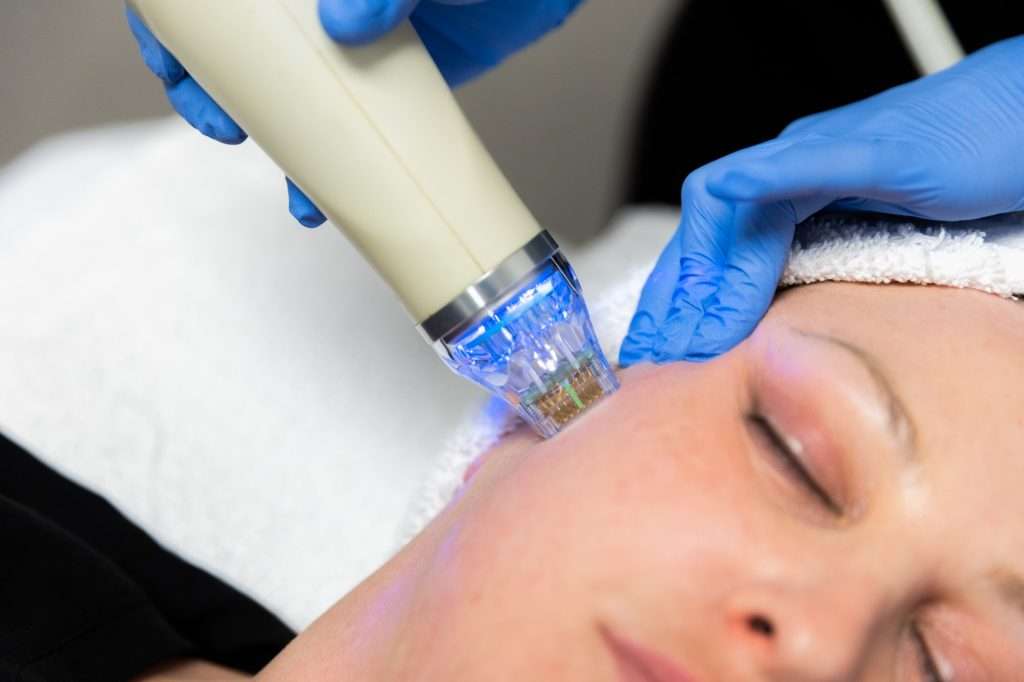 RF microneedling acne scars treatment close up
