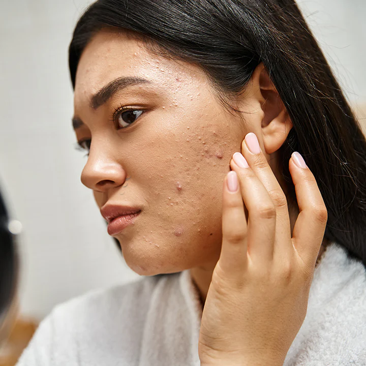 best acne and acne scar treatments in San Diego at Allurant Medical Spa