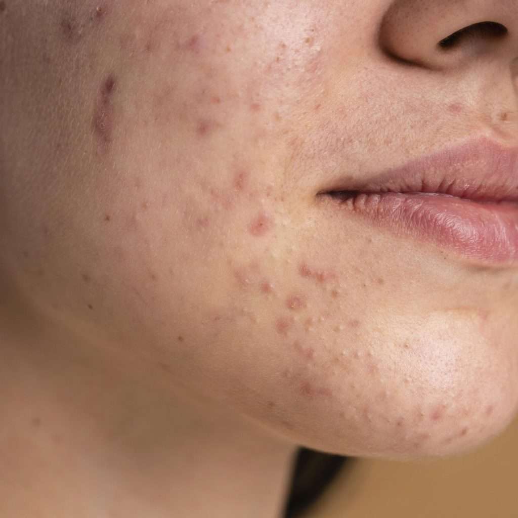 RF microneedling acne scars treatment close up