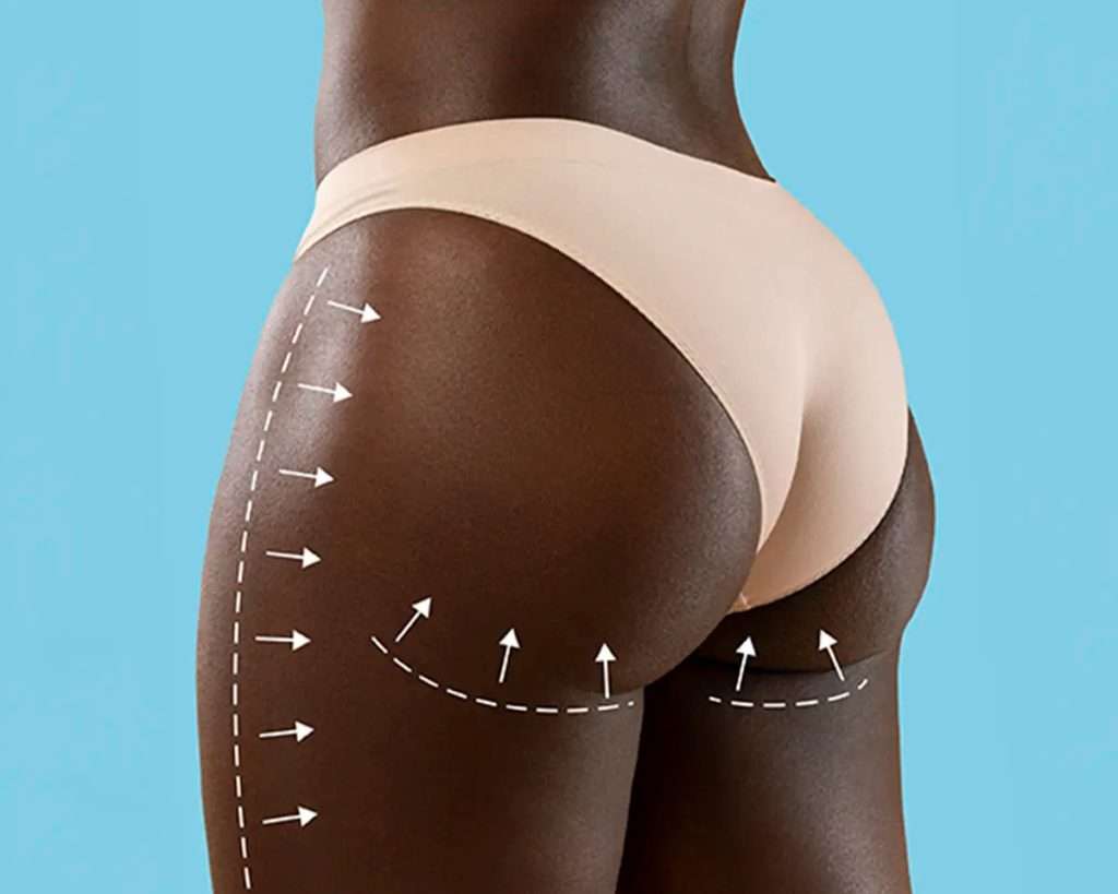 butt lift San Diego natural contour enhancement