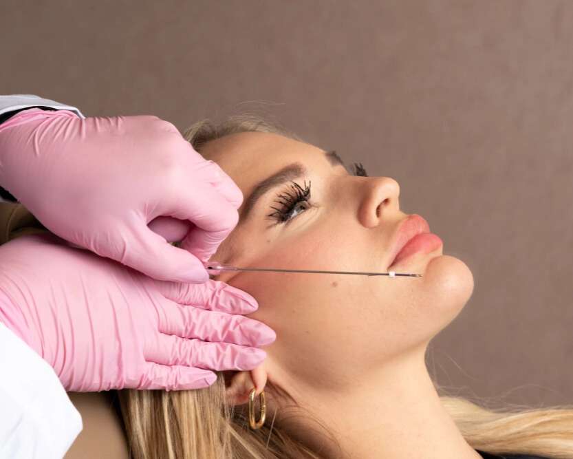 PDO thread lift treatment lifting sagging skin and improving facial contours at Allurant Medical Spa in San Diego