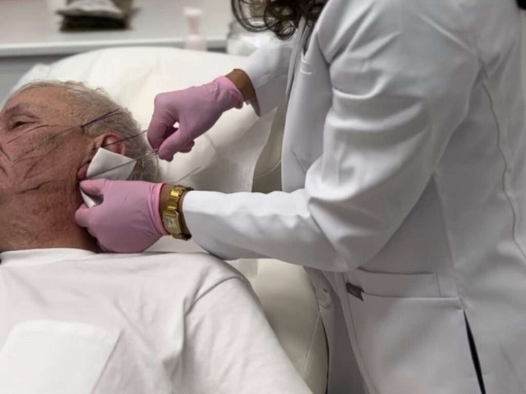 PDO thread lift for jawline tightening and improved facial definition