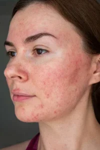 Patient with Rosacea and redness before Adva Tx treatment in Carmel Valley