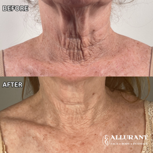Advatx laser benefits smoother skin