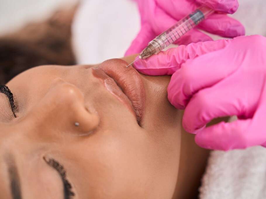 Lip filler treatment results at Allurant Medical Spa San Diego
