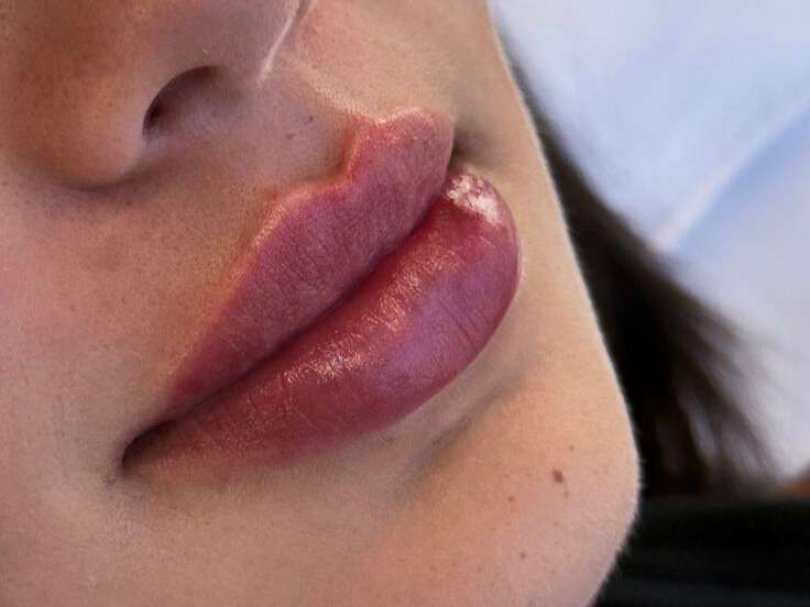 natural looking lip filler results at Allurant Medical Spa San Diego lip enhancement treatment